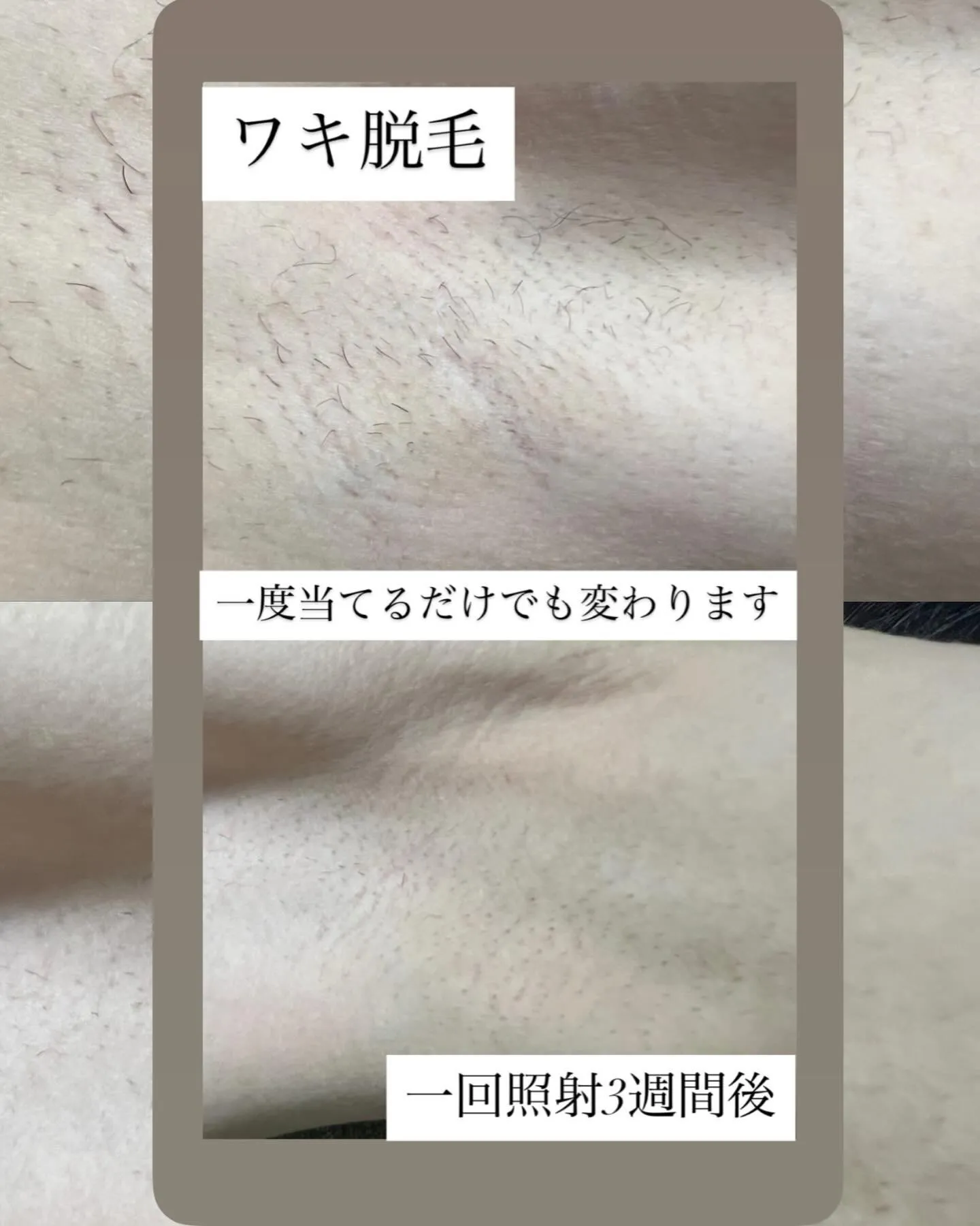 〜ワキ脱毛〜