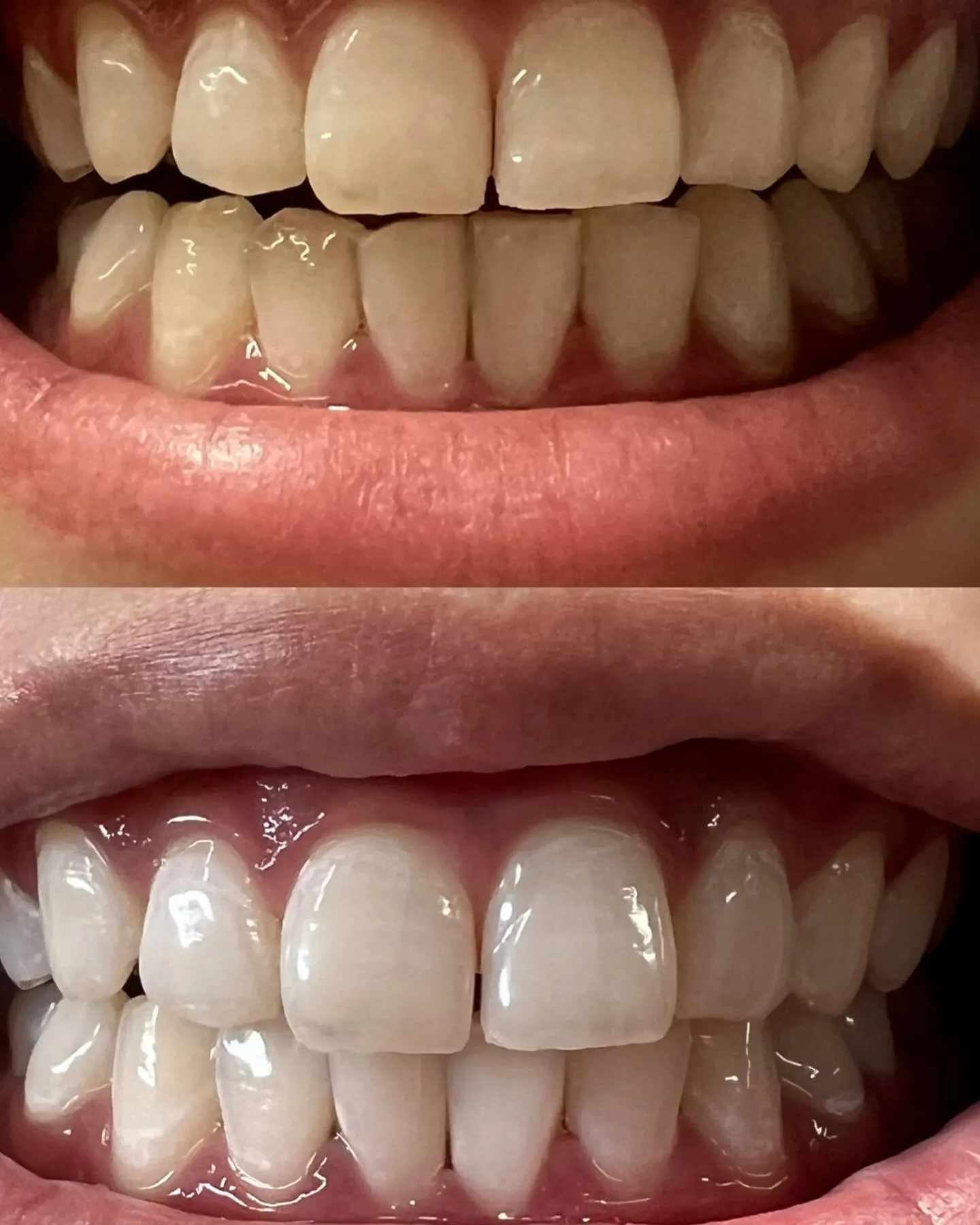 《ホワイトニング》before→after