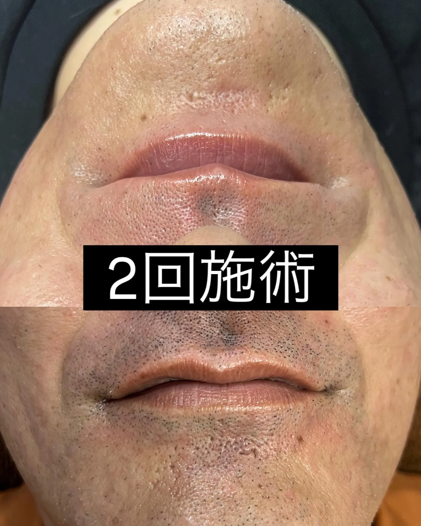 メンズ髭脱毛🧔‍♂️