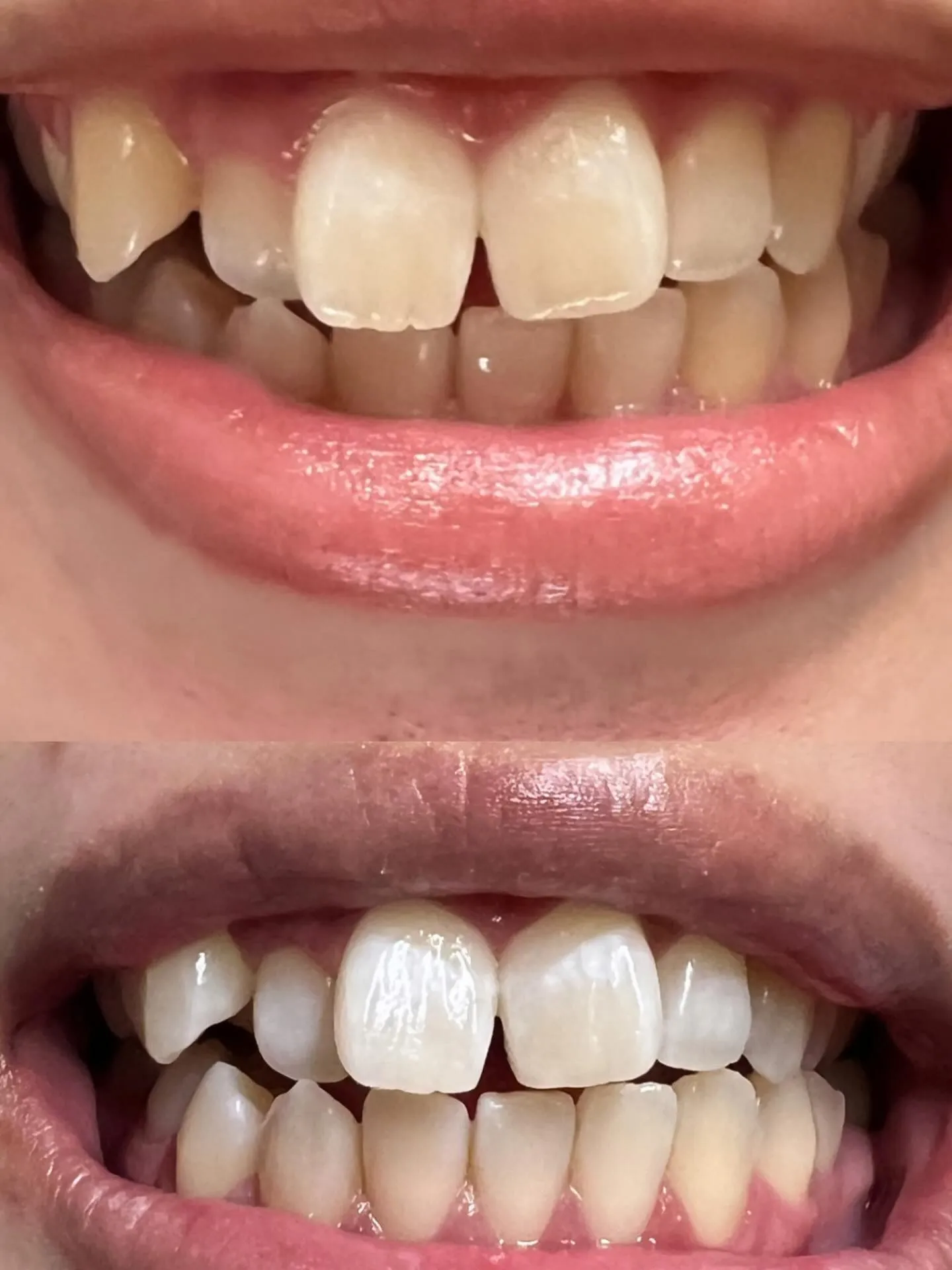 🦷whitening🦷before→after