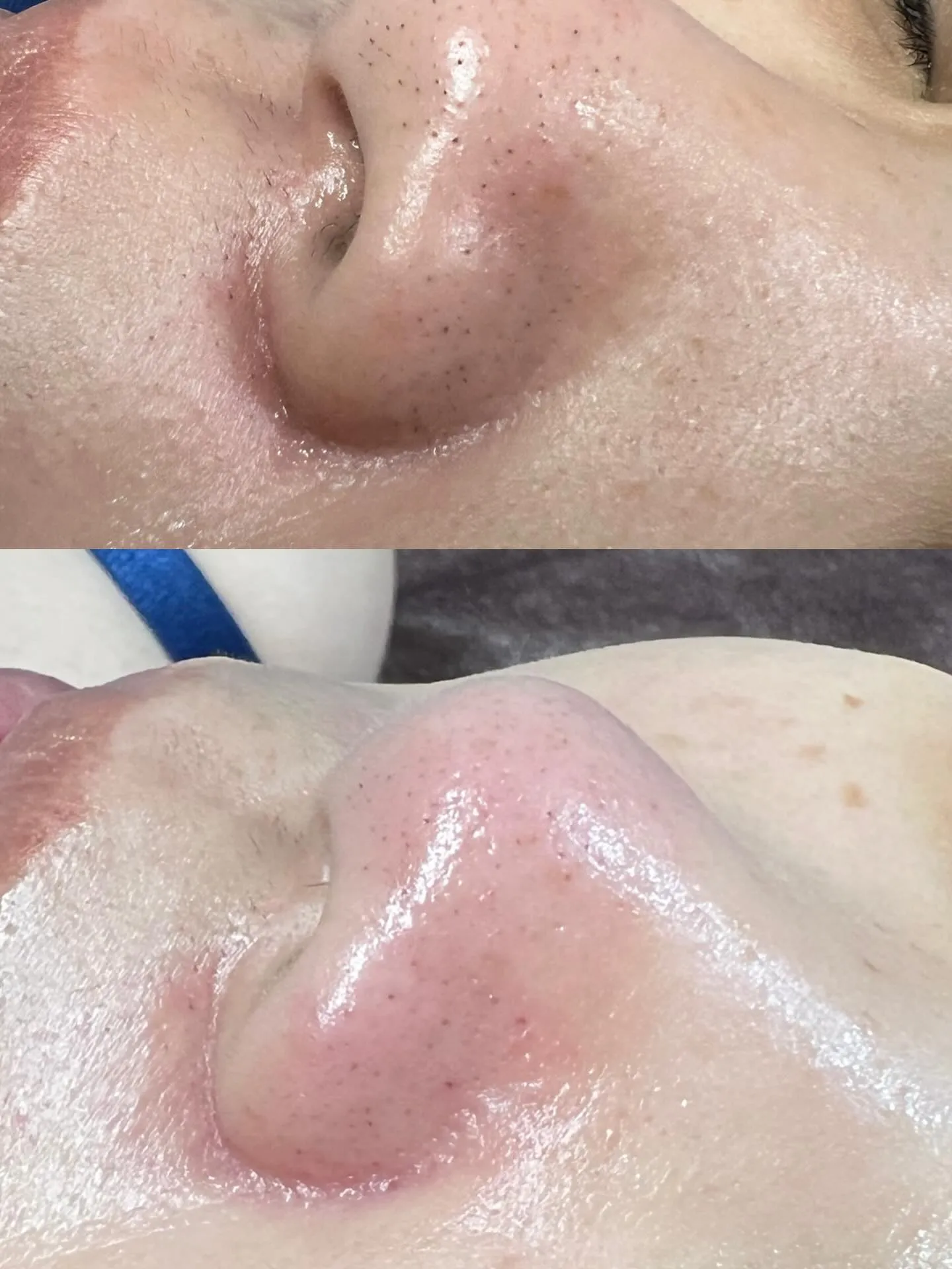 🫧毛穴洗浄&肌トリートメント🫧