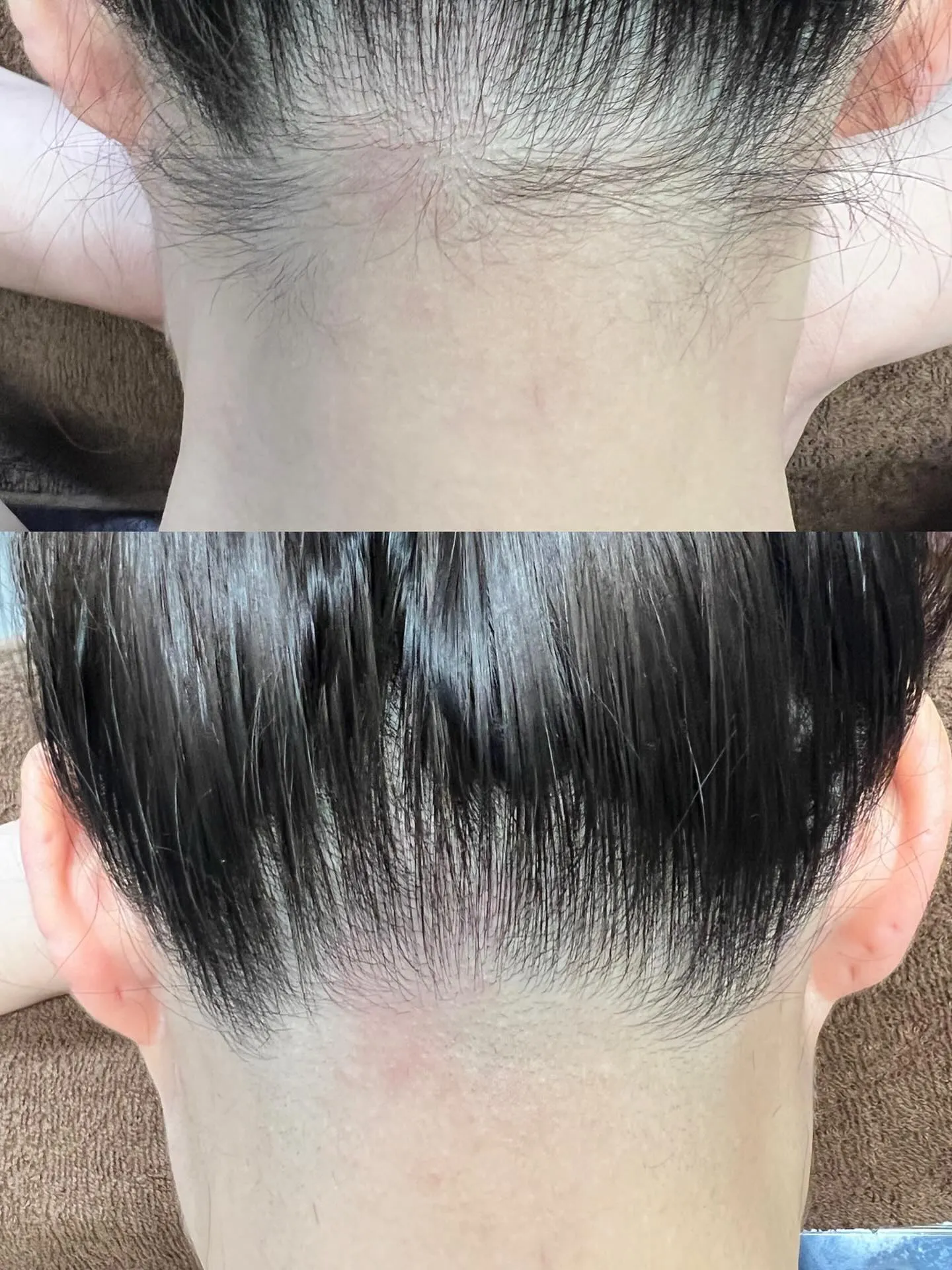 うなじ脱毛✨1回目✨