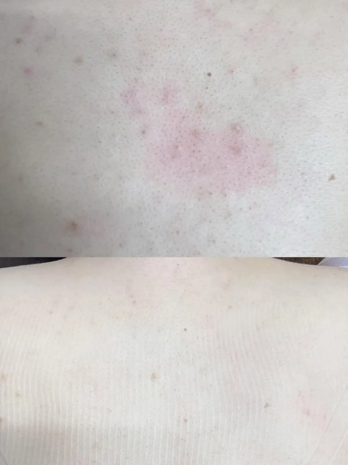 🫧🫧背中ピーリング🫧🫧