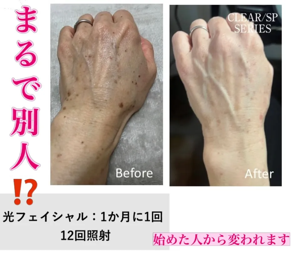 光フェイシャル💡