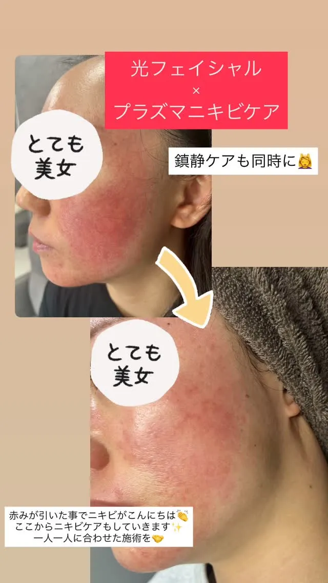 当店自慢の光フェイシャル💡